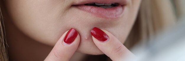 Young woman squeezing out pimple with her hands closeup problem facial skin concept