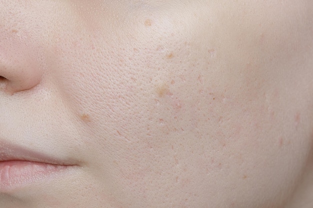 Photo young woman suffering from problem skin and acne closeup icepick scars acne on cheek