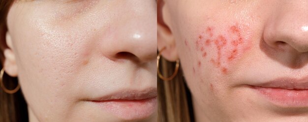 Young woman suffering from problem skin Treatment of ice pick scars Erbium laser facial resurfacing