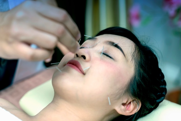 young woman undergoing acupuncture treatment at the health spa