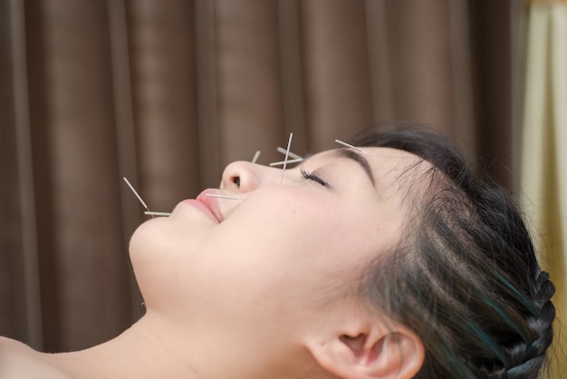 Young woman undergoing acupuncture treatment