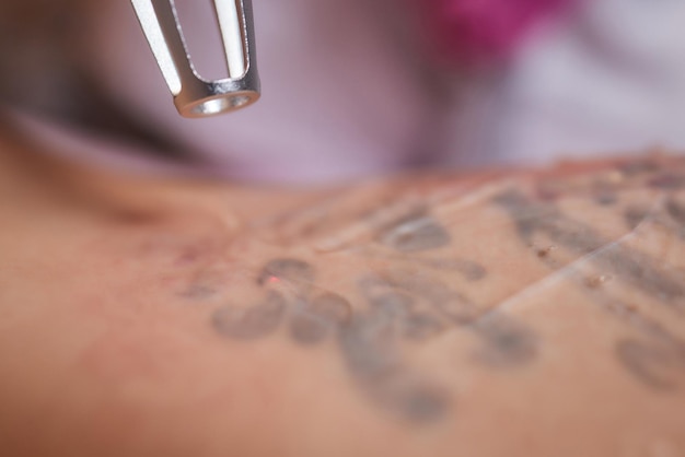 Young woman undergoing laser tattoo removal procedure in salon closeup