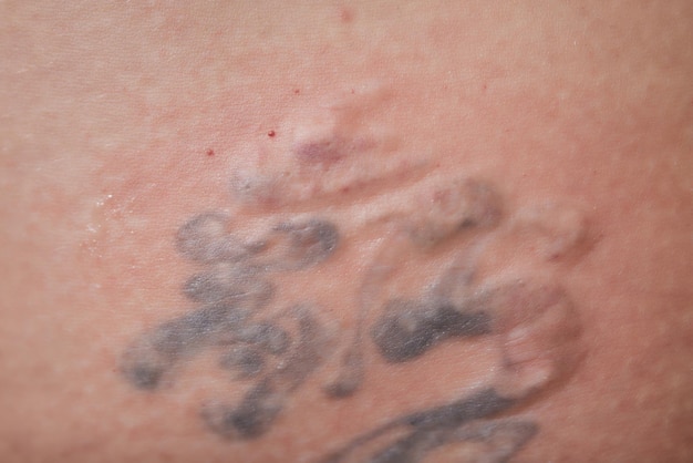 Infected Tattoos 5 Things to Look For After Getting Inked