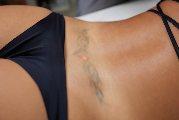 Young woman undergoing laser tattoo removal procedure in salon closeup