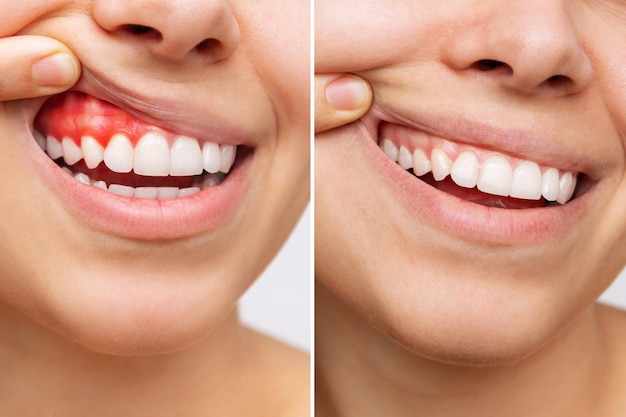 Photo young woman with red bleeding gums and health gums before and after treatment