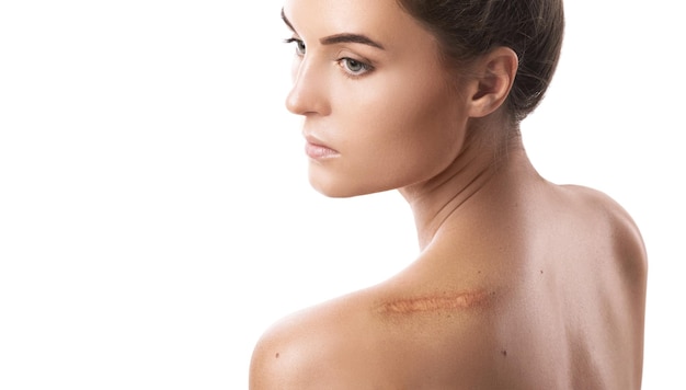 Young woman with a scar on her shoulder over white background