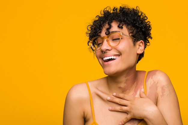 Young woman with skin birth mark laughs out loudly keeping hand on chest