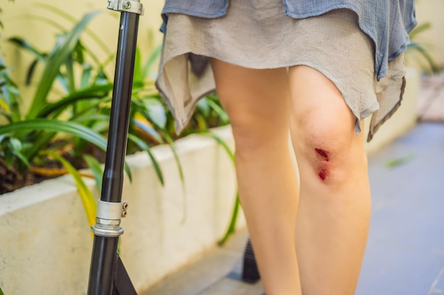 Young woman with a wound on her knee fell off a scooter