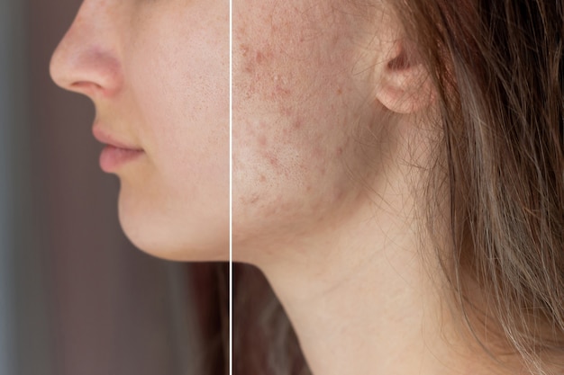 Photo a young womans face before and after acne treatment on face pimples red scars rash on cheeks