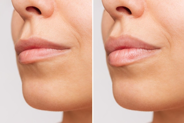 Photo a young womens face with lips before and after lip enhancement injection of filler in lips