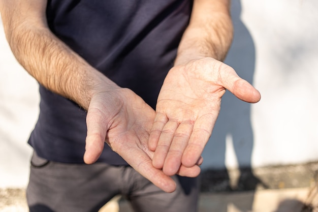 Zeer droge handen aanraken, schilferen door wasalcohol