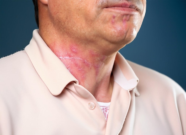 Ziektesymptomen roodheid van de huid gegenereerd door AI
