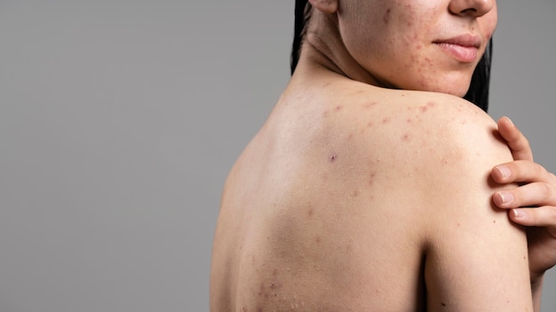 Foto zijaanzicht jonge vrouw met acne