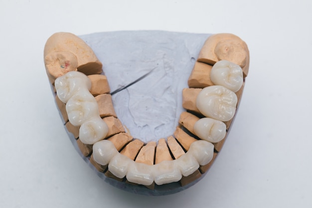 Photo zirconium porcelain tooth plate in dentist store. ceramic bridge on plaster model.