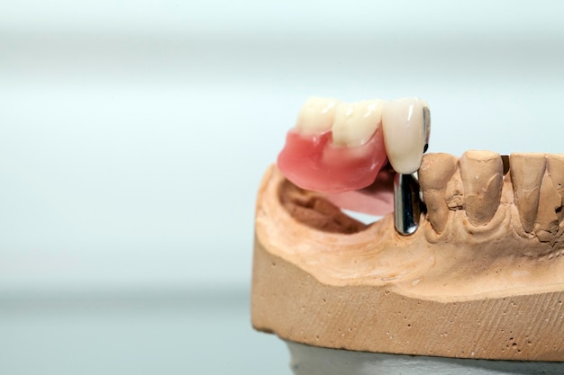 写真 歯科医院の写真のジルコニウム磁器の歯のプレート