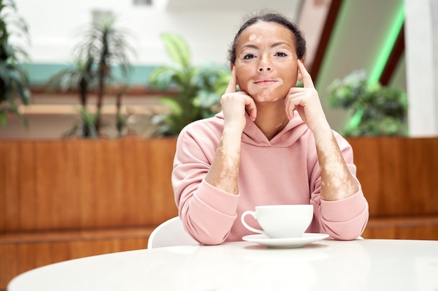 Zwarte Afro-Amerikaanse vrouw met vitiligo pigmentatie huidprobleem binnen gekleed roze hoodie zittend op de tafel drinken thee witte dop denken Drweaming vrouw