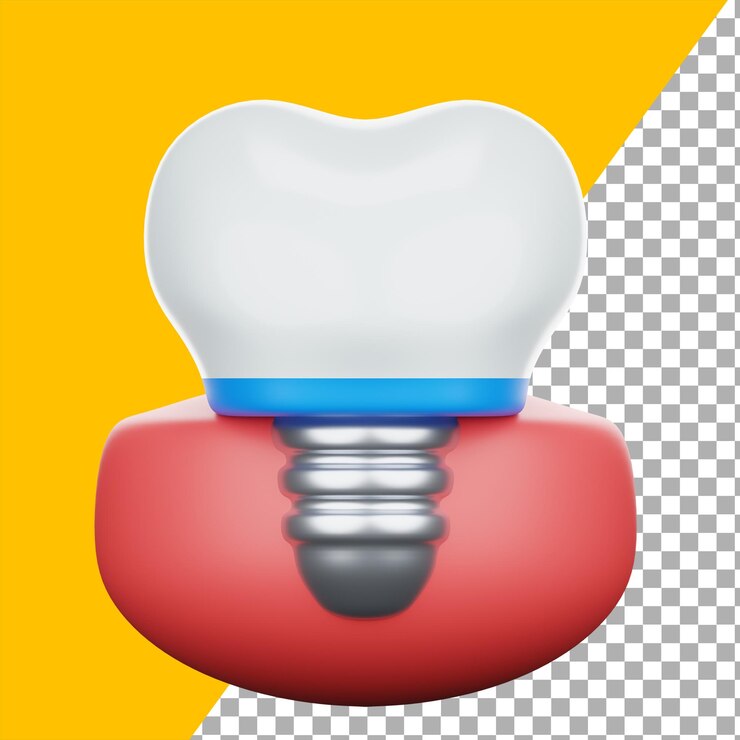 3D 치과 임플란트