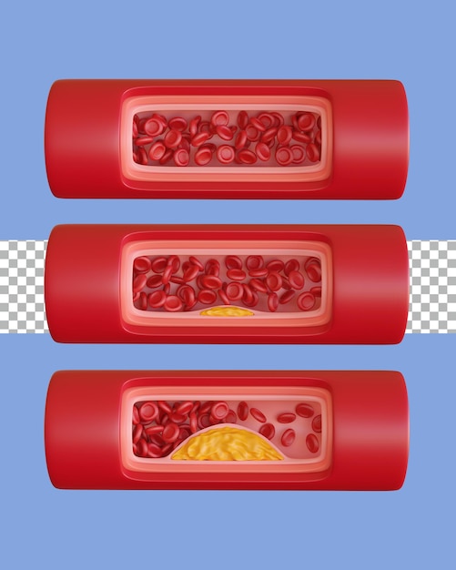 3D 렌더링 동맥 죽상경화증 전면 3단계 투명