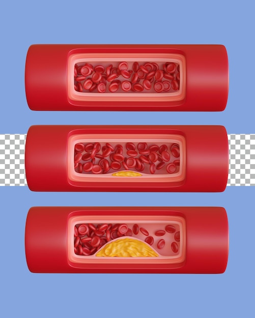 PSD 3 d レンダリング動脈アテローム性動脈硬化症フロント 3 ステップ透明