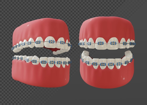 PSD rappresentazione 3d dei denti che indossano la vista prospettica delle parentesi graffe