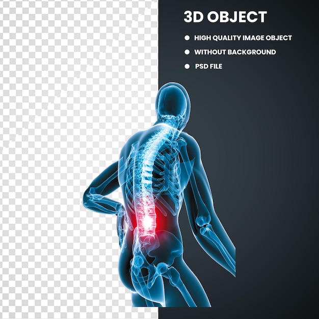 PSD 허리 통증