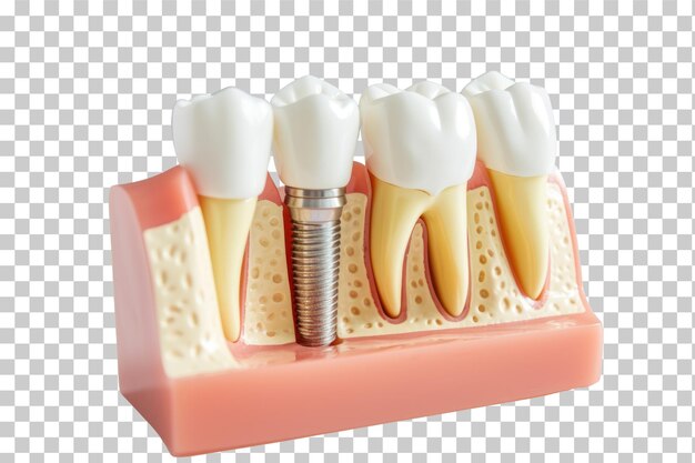 PSD 透明な背景の歯科インプラント