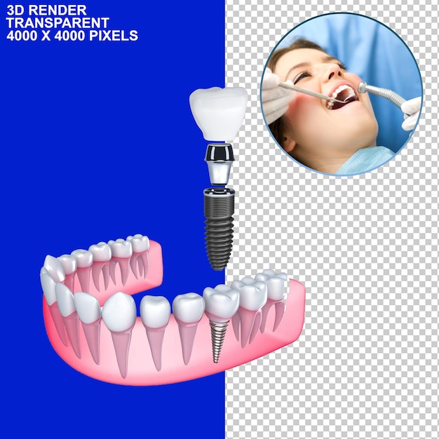 PSD trattamento dentale tessere dentale implant dentale osservazione dentale controllo dentale dolore dentale dentista