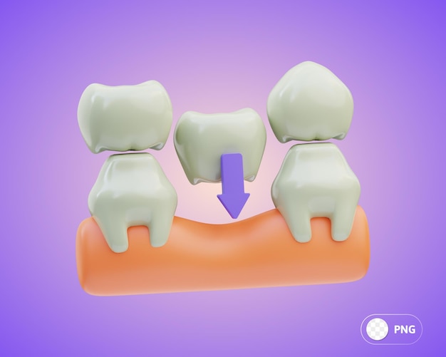 Ilustracja Dentystyczna Mostu 3d