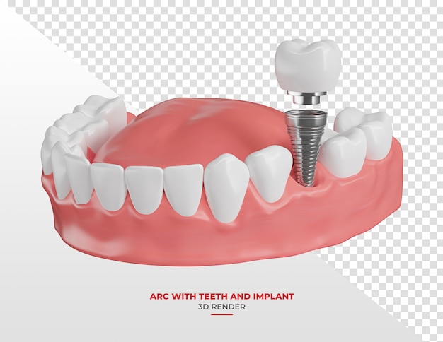 PSD kauwgom met tand en implantaat in 3d-weergave met transparante achtergrond