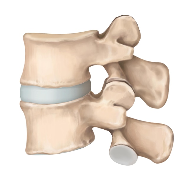 PSD lumbar spine