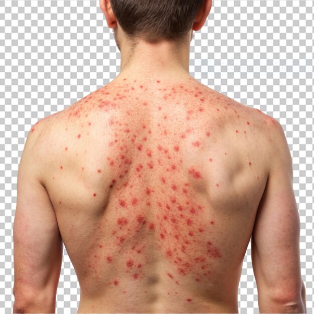 PSD male back affected by blistering rash on transparent background