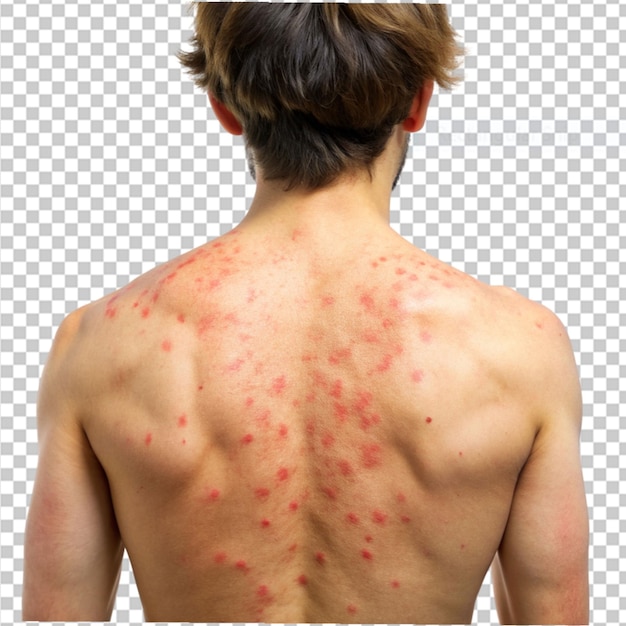 PSD male back affected by blistering rash on transparent background