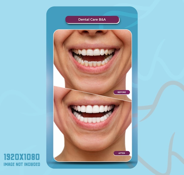 PSD psd instagram story prima e dopo la cura dentale hollywood modello di progettazione del sorriso