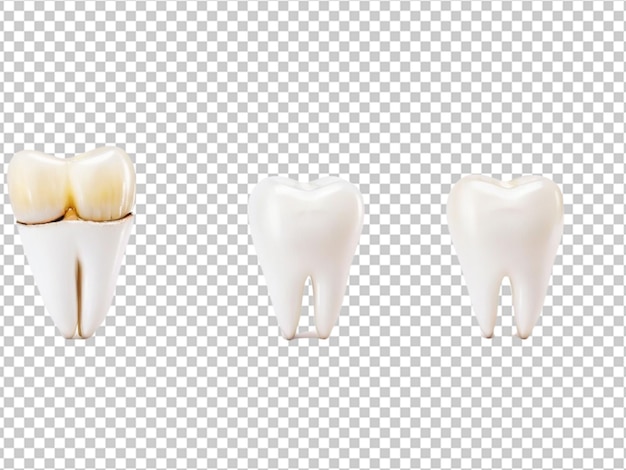 PSD psd of a tooth