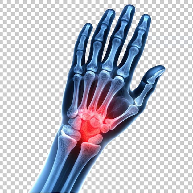 PSD artrite reumatoide o gotta röntgen della mano umana 39s vista obliqua dolore alla mano su sfondo trasparente