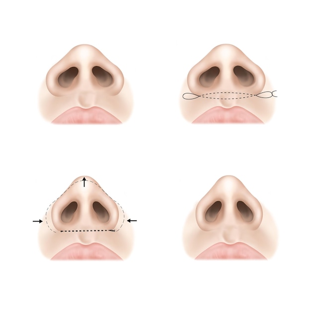 PSD rhinoplastie