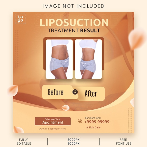 Sociale media voor definitieve resultaten van liposuctiebehandeling met afbeeldingen voor en na