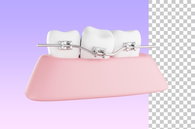 PSD system aparatów ortodontycznych do korekcji zgryzu