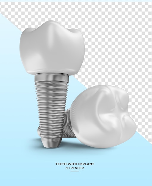 PSD tand met implantaten in 3d rendering met transparante achtergrond