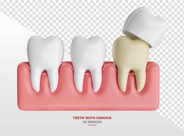 PSD teeth in gum with dental crown in 3d render with transparent background