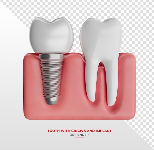 Denti con impianti in rendering 3d con sfondo trasparente