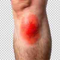 PSD unrecognizable man feel bad on skin disease called psoriasis large red inflamed rash on elbows on transparent background