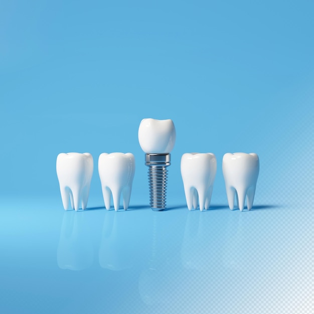 PSD white tooth implant implant cut healthy tooth or dental surgery