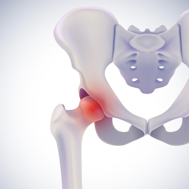 Vector 3d illustration of anterior view of hip bone showing painful position on white