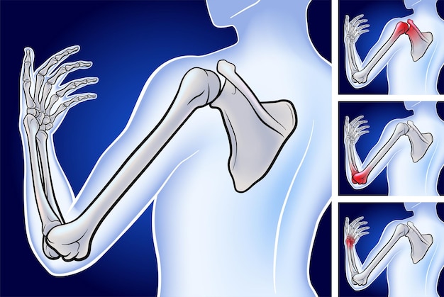 Vector 3d illustration of bone from scapula to fingertip showing the location of three pain points on a dark blue background