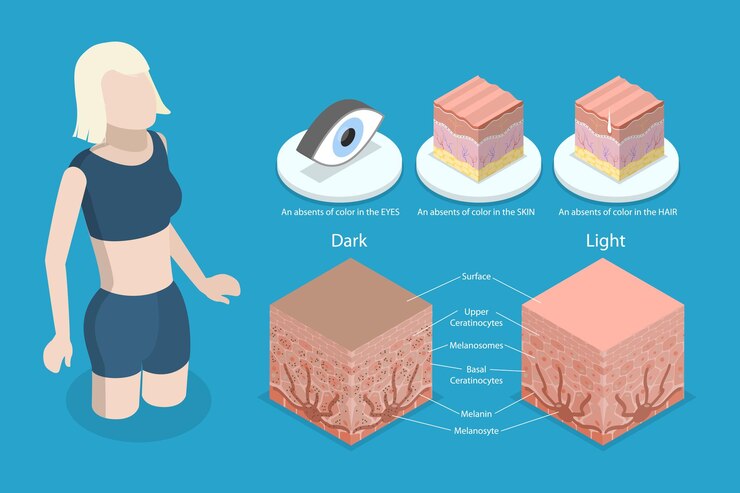Vector 3d isometric flat vector conceptual illustration of albinism