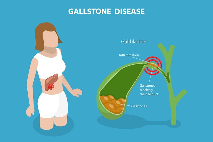 Vector 3d isometric flat vector conceptual illustration of gallstone disease