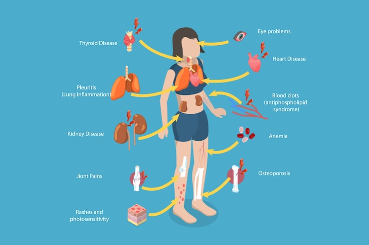 Vector 3d isometric flat vector conceptual illustration of lupus erythematosus