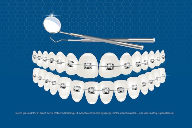 3D-vector illustratie realistische tanden met beugels boven- en onderkaak Uitlijning van de beet van tanden gebit met beugels beugels