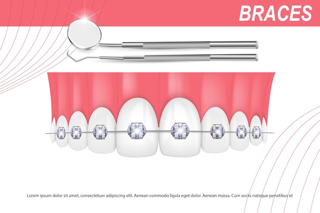 3d векторная иллюстрация реалистичные зубы с брекетами верхняя и нижняя челюсть Выравнивание прикуса зубов зубной ряд с брекетами брекеты